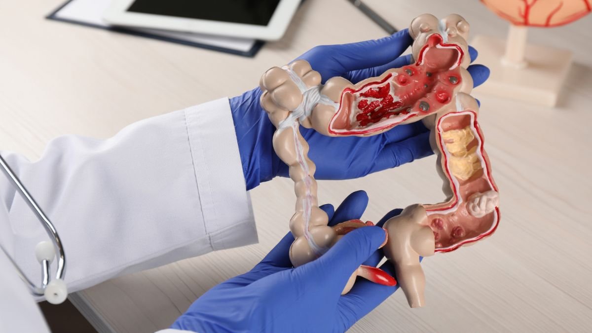 Virtual Colonoscopy — no scope, no sedation